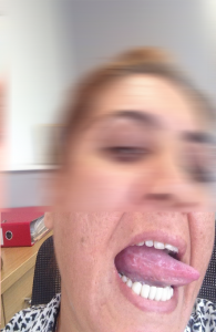 Dilde Hemanjiom Tedavisi