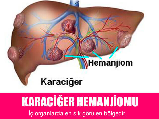Karaciğer Hemanjiomu